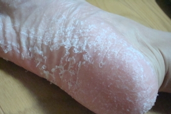 裏 足 お 上がり むける 皮 の 風呂 が 足の裏の皮が剥けて困っています。毎年夏になると足の裏の皮がむけるん
