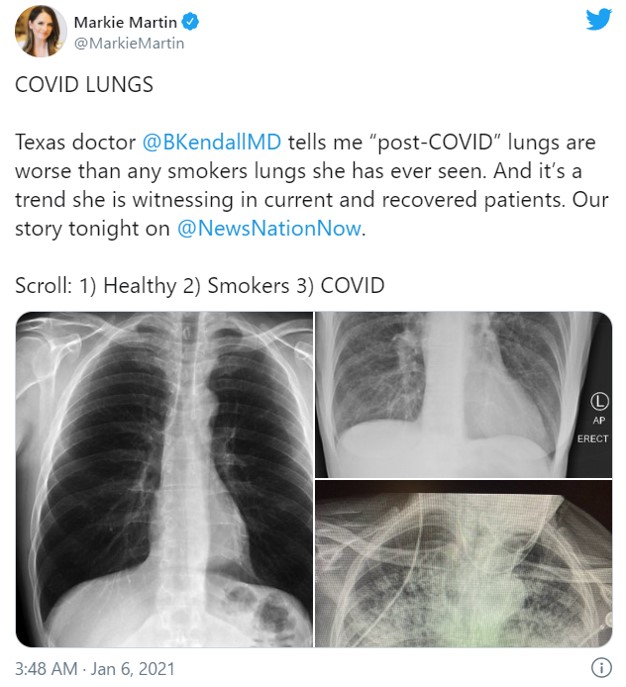 新型コロナウイルス感染後の肺と喫煙者の肺を比較したレントゲン写真 自分の目で見ないと事態がどれだけ深刻か理解できない人が多すぎる いまだに ただの風邪でしょ って言ってる人いるもんな ガジェット通信 Getnews